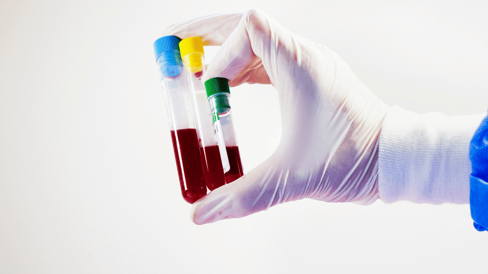 Melhor preço de exame toxicológico em Guarapari. Agende no Laboratório Nossa Rede e tenha rapidez, segurança e qualidade.